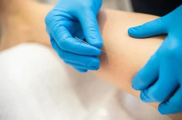 Dry needling treatment for muscle trigger points at Active Performance Clinic